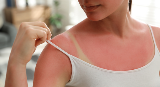 Beat the Heat of Summer: Sunburn Relief, Dryness, and Moisturize